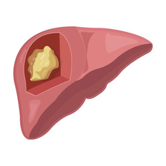 liver cancer isolated on white background