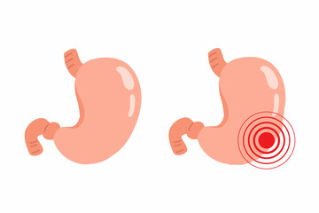 Stomach. Healthy and ailing stomach. Cartoon internal organs. Gastritis and inflammation. Improper diet, acid, infection. Vector illustration isolated on white background.