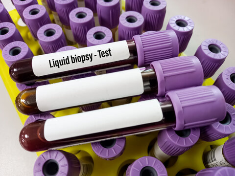 Blood samples for Liquid biopsy blood test to detect cancer cells or DNA fragments that circulate in the bloodstream, Lung cancer, laboratory background