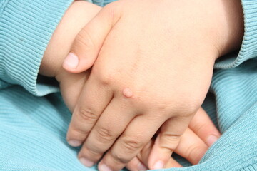 A wart on boy's hand.