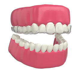 invisible orthodontic teeth 3d illustration on white background