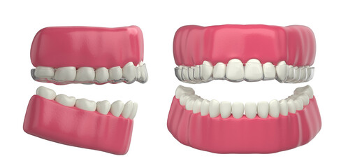 invisible orthodontic dentures on white background 3d illustration