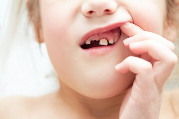 Obraz premium A little girl lost her baby milk tooth. Lost temporary tooth. The concept of oral hygiene in children. Close-up of the oral cavity