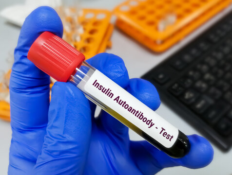 Insulin Autoantibody Or Autoantibodies Against Insulin Or IAA Blood Test.