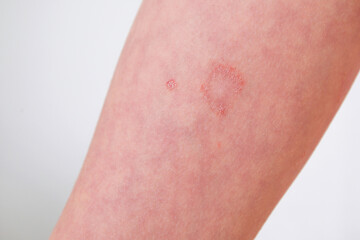 The child has allergic contact dermatitis on the skin. - obrazy, fototapety, plakaty