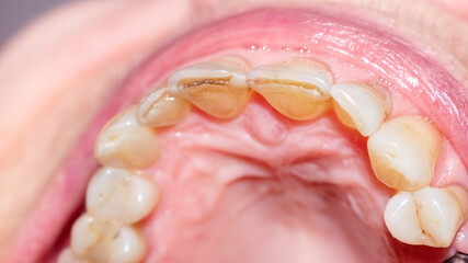 Close-up of a worn and fractured dentition of an elderly lady. Upper arch of teeth with severe...