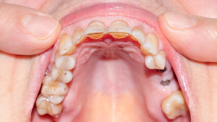 Dental overview of the upper arch of an elderly woman with fractured, worn out teeth.
