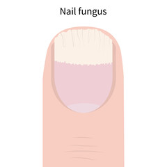 Nail fungus on the hand. Schematic image, vector illustration