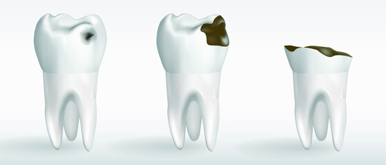 stages of caries. Stages of tooth decay. Vector realistic illustration