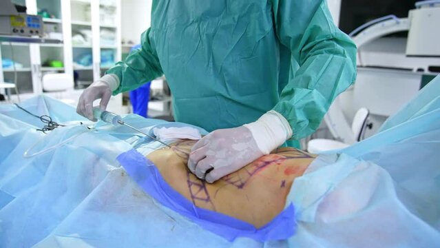 Plastic surgeon conducts liposuction operation. Doctor uses a large syringe with long needle for abdominoplasty.