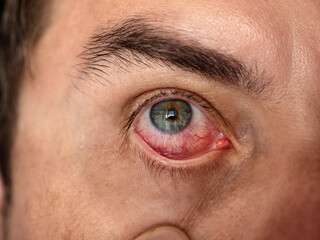 Man with red eye, macro. Conjunctivitis infection.