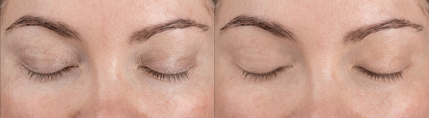 Skin around eyelids, eyes before and after application of care cosmetics or cosmetic procedures,...