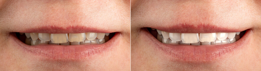 Smile before and after using bleaching agent, toothpaste, professional teeth cleaning. Partial view...