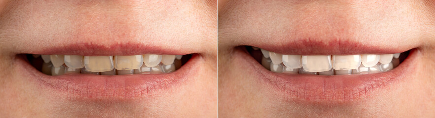 Smile before and after using bleaching agent, toothpaste, professional teeth cleaning. Partial view of smiling woman before and after teeth whitening