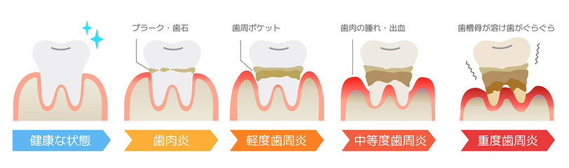 歯周病(歯肉炎)の重症度・プラーク・歯石による歯肉の腫れ・出血・歯周ポケット