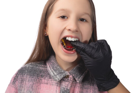 A doctor in black medical gloves tries on an orthodontic appliance for a little girl. The concept of teeth alignment in childhood. Studio photo on a white background.