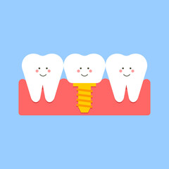 Installed happy dental implant. Illustrations for dentistry. Vector illustration.