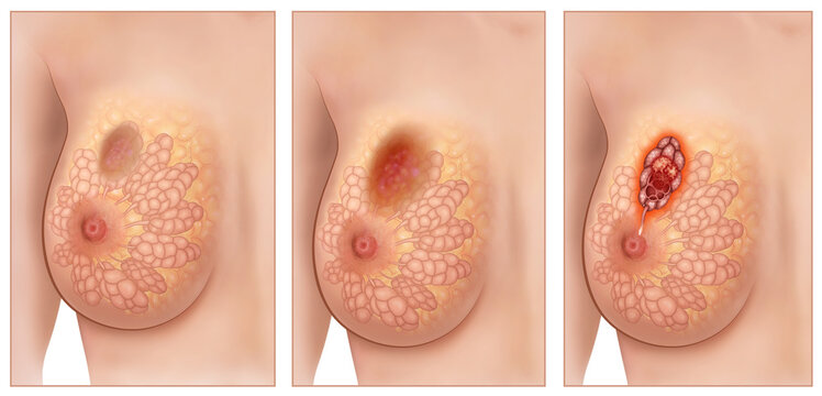 Estadios de un tumor de mamas