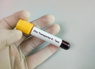 Obraz premium Zinc transporter 8 (ZnT8) antibody test to distinguishes type 1 and type 2 diabetes mellitus