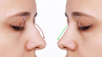 A profile of woman's face with nose before and after rhinoplasty isolated on a white background....