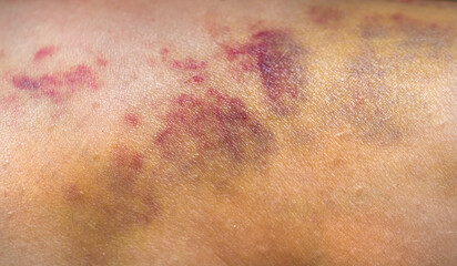 Bruises on the human body. Severe bruise from impact, bruising and hematoma.