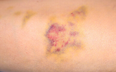 Bruises on the human body. Severe bruise from impact, bruising and hematoma.