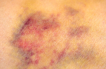 Bruises on the human body. Severe bruise from impact, bruising and hematoma.