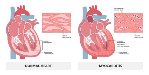 Cardiology high blood pressure Heart attack mRNA lupus viral vaccine ECG COVID-19 virus ECMO rapid chest pain leg ankles feet transplant giant cell infectious