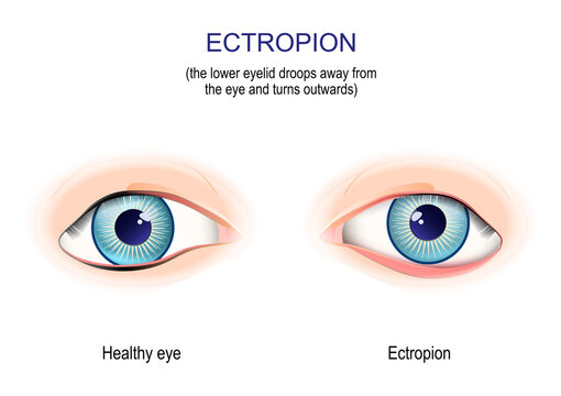 Ectropion. The Lower Eyelid Droops Away From The Eye And Turns Outwards.