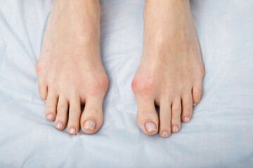 The woman suffers from inflammation of the big toe bone. Hallux valgus, bunion in foot on white background. - obrazy, fototapety, plakaty