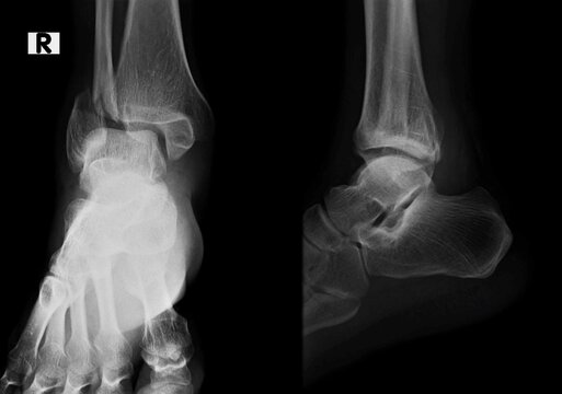 x-ray image of a broken ankle