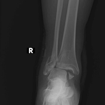 x-ray image of a broken ankle