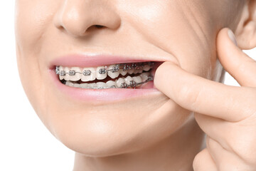 Woman with dental braces on white background, closeup