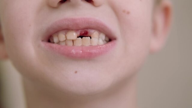 Toothless smile Blonde caucasian baby boy without milk tooth in mouth, children dentistry stomatology and losing first premolar tooth