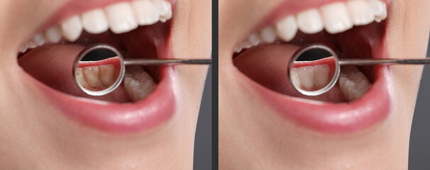 Collage with photos of woman before and after professional treatment of dental plaque, closeup....