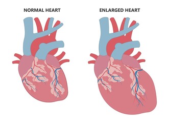 Fototapeta premium Enlarged athlete's heart angina x-ray edema test diagnose chest pain high blood pressure sudden death shock stress test