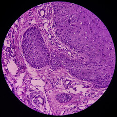 Micrograph of verrucae or chin skin wart, microscopic show epidermal hyperplasia with hyperkeratosis and papillomatosis. dense infiltration of polymorphs, lymphocytes, histiocytes.