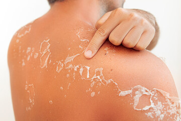 Fototapeta premium Peeling skin dermatology conditions at man back and shoulder, flaking skin and skincare concept