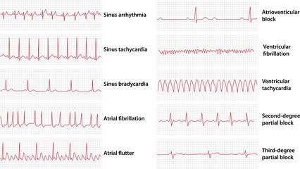 Schemes set of common electrocardiogram (ECG) abnormalities, including partial blocks and flutter - obrazy, fototapety, plakaty