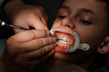 The orthodontist installs braces for the student's boyfriend, visits to the dentist, installation...