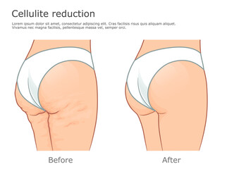 Cellulite and healthy skin vector illustration. Before and after reduction procedure. 