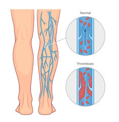 Deep vein thrombosis or DVT vector medical illustration. Healthy and unhealthy vein.  - obrazy, fototapety, plakaty