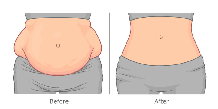 Woman's belly before and after weight loss. Vector illustration.