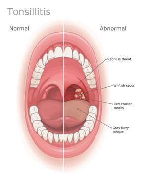 Tonsillitis medical illustration. Normal oral cavity and tonsillitis symptoms labeled. 