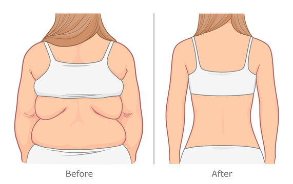 Back Weight Loss Illustration. Woman's Back Before And After Weight Loss. 