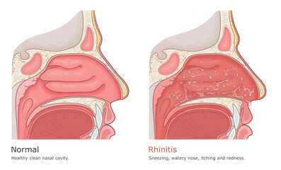Rhinitis medical illustration. Normal nasal cavity and rhinitis symptoms. - obrazy, fototapety, plakaty