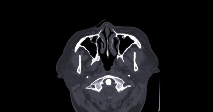 CT paranasal sinus protocol serves as an examination for the assessment of the study of the mucosa and bone system of the sinonasal cavities. 