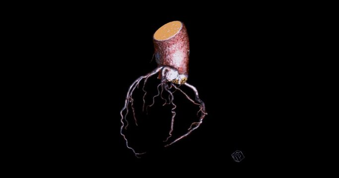 CTA Coronary artery 3D rendering turn around on the screen for diagnosis of vessel coronary artery disease .