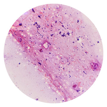 Cocci and bacilli  bacteria in urine under 100X light microscope. Smear of human urine sediment Gram's stained with gram positive and negative bacteria. Urinary tract infection.