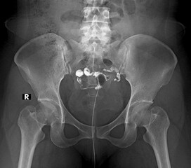 x-ray image of  partial obstruction  Hysterosalpingography (HSG)